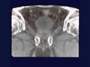 Cancer-Care-Institute-Cone-Beam-CT-Pelvic